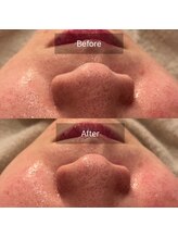 ステラグランデ(Stella grande)/浮き出た毛穴詰まりを除去！