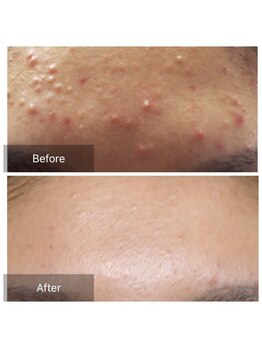 エミルカ 自由が丘店(EMILUCA)/おでこ 思春期ニキビ