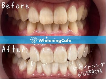 ホワイトニングカフェ 豊中店(WhiteningCafe)/◎歯のホワイトニング施術写真◎