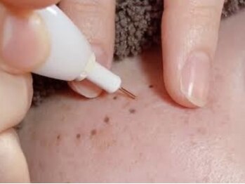 トムズ(Tom’s)の写真/今人気のシミケアコース☆4つの高機能でシミ＆肌悩みにアプローチ！自信を持った素肌を手に入れましょう♪