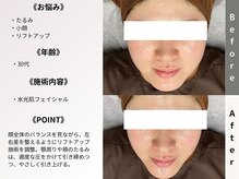 ルディラ 上野店/水光肌フェイシャル