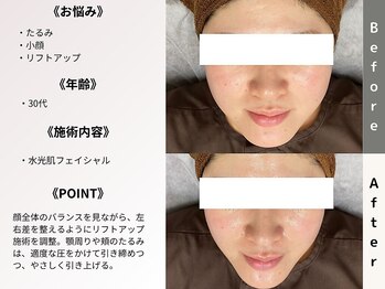 ルディラ 上野店/水光肌フェイシャル