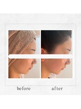 サロンドビューティー 美ふぅ(salon de beauty 美ふぅ)/二重あご