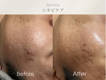 フェイシャルサロン ベルダ(BELDA)/【ニキビケアBefore After 】