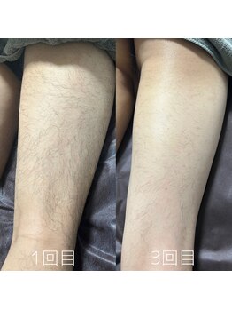 カナウ(KANAU)/足脱毛（20代前半男性）