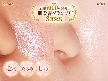 プライベートサロン 美月の写真/フェイシャル人気No.1【毛穴徹底改善】凸凹/開き/黒ずみ/ゴワつきを根本改善!!ツヤぷるで毛穴レスなお肌に