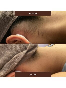 チャンティック(Cantik)/成人式のうなじケアのお客様♪