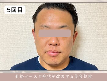 ほぐし屋 かすがい/5回目/小顔リフト+美姿勢整体
