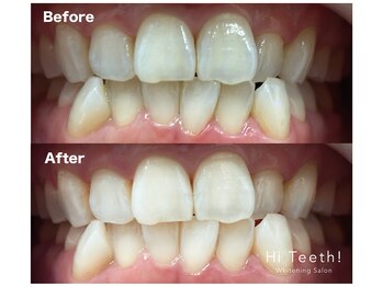 ハイティース 高田馬場店(Hi Teeth!)/美容セルフホワイトニング