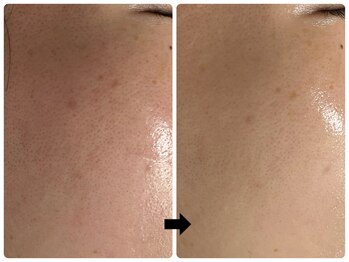 エフェクト 塚口店(effect)/Before After 20代/1回目