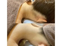 人気のうなじ脱毛！形を見極めながらデザインします