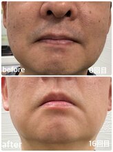 セルフ脱毛サロン　SELFMADE イオンタウン仙台泉大沢店【3/29 NEW OPEN（予定）】 /【ビフォーアフター】セルフ脱毛