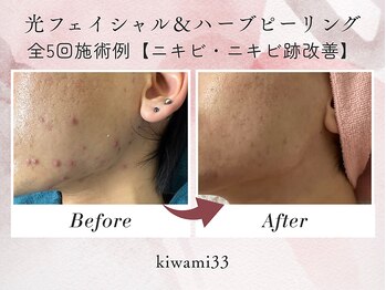 キワミ サーティスリー(kiwami33)/kiwami33モニター様、5回施術例
