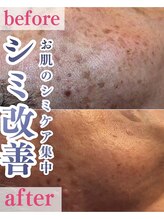 メルスィ 千歳店/メンズのシミ集中ケア