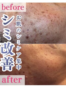 メルスィ 千歳店/メンズのシミ集中ケア