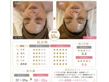 ビ フェイス(Bi-face)/蓄熱式超音波