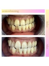 エクシアホワイトニング 郡山店/ホワイトニングビフォーアフター