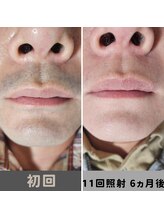 キムラケ 和光別邸(木村家 KIMURAKE)/【衝撃】メンズ脱毛ヒゲの変化