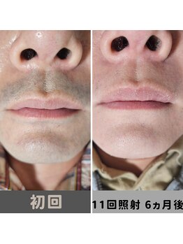 キムラケ 和光別邸(木村家 KIMURAKE)/【衝撃】メンズ脱毛ヒゲの変化