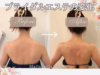 マリスステラ 天王寺(MarisStella)/ブライダルエステ1ヶ月☆