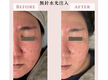 レクラ バイ ドクターエイチ(L'ECLAT by Doctor.H)/無針水光注入”美容液真皮導入”