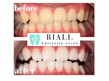 リアリ 宮崎(RIALI.)/プラチナホワイトニング