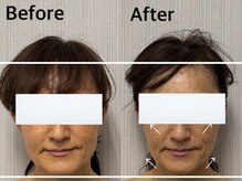 ベール(BEHL)/コルギ＆石膏のBefore After