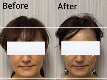 ベール(BEHL)/コルギ＆石膏のBefore After