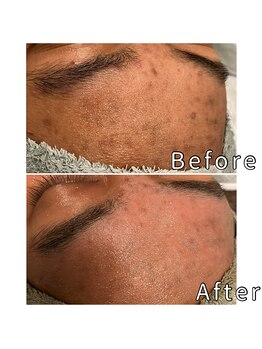 エヌプラス(N+)/30代女性＊ピーリング3回後(3)