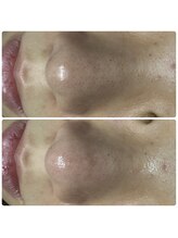 ユニ(uni.)/毛穴エクストラクション症例