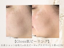 アネラボーテ(Anela Beaute)/Gloss肌ピーリング　艶玉リフト