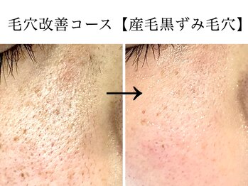 ベアトリーチェ 五反田(Beatrice)/毛穴改善コース/産毛黒ずみ毛穴