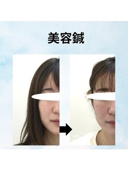 ゆず鍼灸整骨院/美容鍼