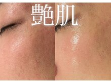 エス(es)の雰囲気（話題の水玉リフティング/LDM！再生力＆免疫システムUP）