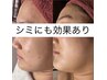 夏前に本格美肌ケア☆【シミ集中ケア】REVIハーブピーリング￥11，000
