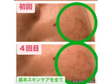 パルティノ 高崎店/シミケアで緩和