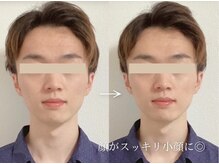 希実鍼灸院(nozomi)/【お顔全体のむくみ・眼精疲労】