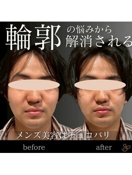 チョコバリ 渋谷店(chocobari)/小顔×リフトアップ(美容鍼)20代