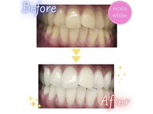 エクシアホワイト 広島袋町店/ホワイトニングビフォーアフター