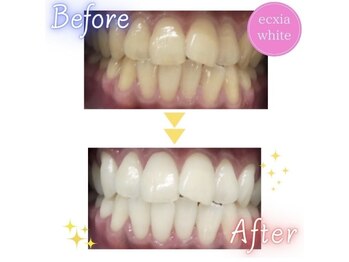 エクシアホワイト 広島袋町店/ホワイトニングビフォーアフター