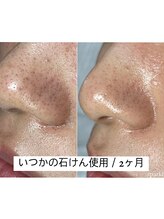 スパークル/フェイシャル/毛穴/黒ずみ