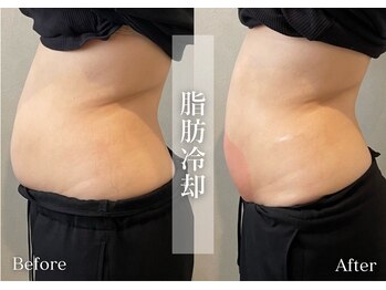 シューラディアント(ShuRadiant)/脂肪冷却