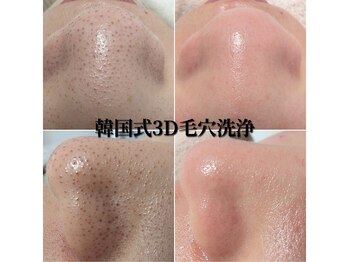 ディオーネ 岡崎店(Dione)/《韓国式3D毛穴洗浄》