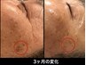 【お悩み別★シミ】あなただけの改善プランをご提案¥8000～¥20000