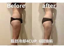 ユー 喜連西店(U)/脂肪冷却【before　after】