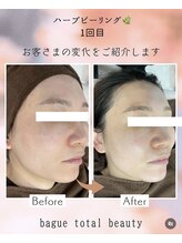 バーグトータルビューティー(bague total beauty)/ダウンタイム無ハーブピーリング