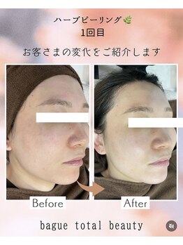 バーグトータルビューティー(bague total beauty)/ダウンタイム無ハーブピーリング