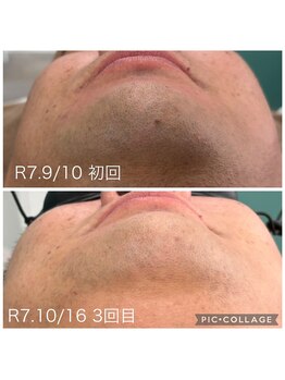 カピリナ(kapilina)/ヒゲ脱毛3回目の経過です！