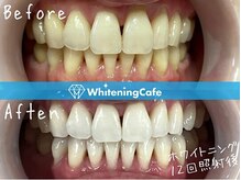 ホワイトニングカフェ 豊中店(WhiteningCafe)/◎歯のホワイトニング施術写真◎