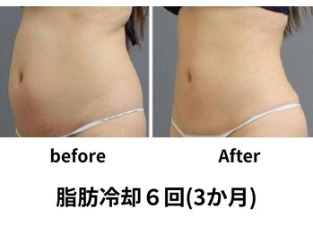 エミット(emit.)/脂肪冷却　ビフォーアフター